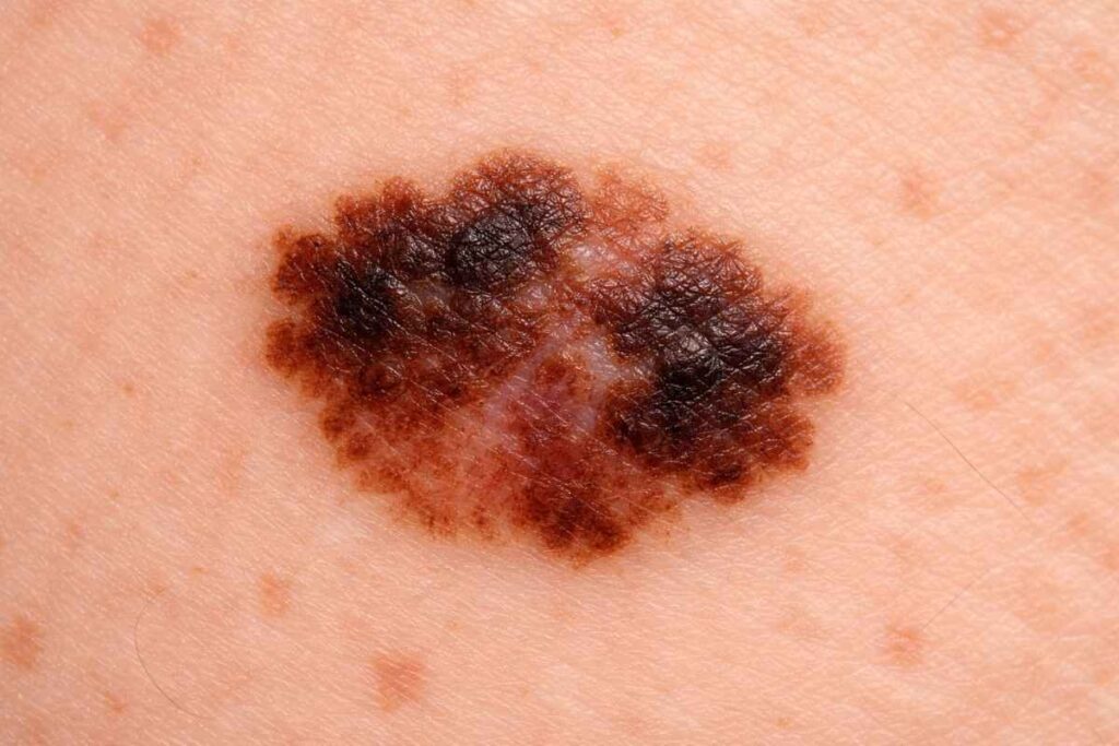 Sores That Don’t Heal