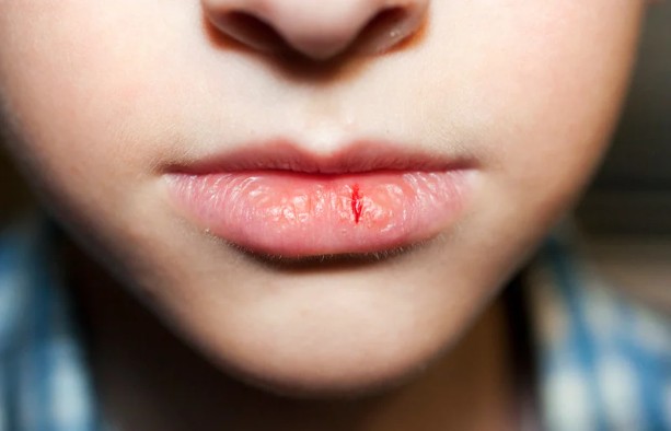 Watch Out for Dry Mouth